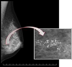 高濃度乳房の場合のマンモグラフィ写真